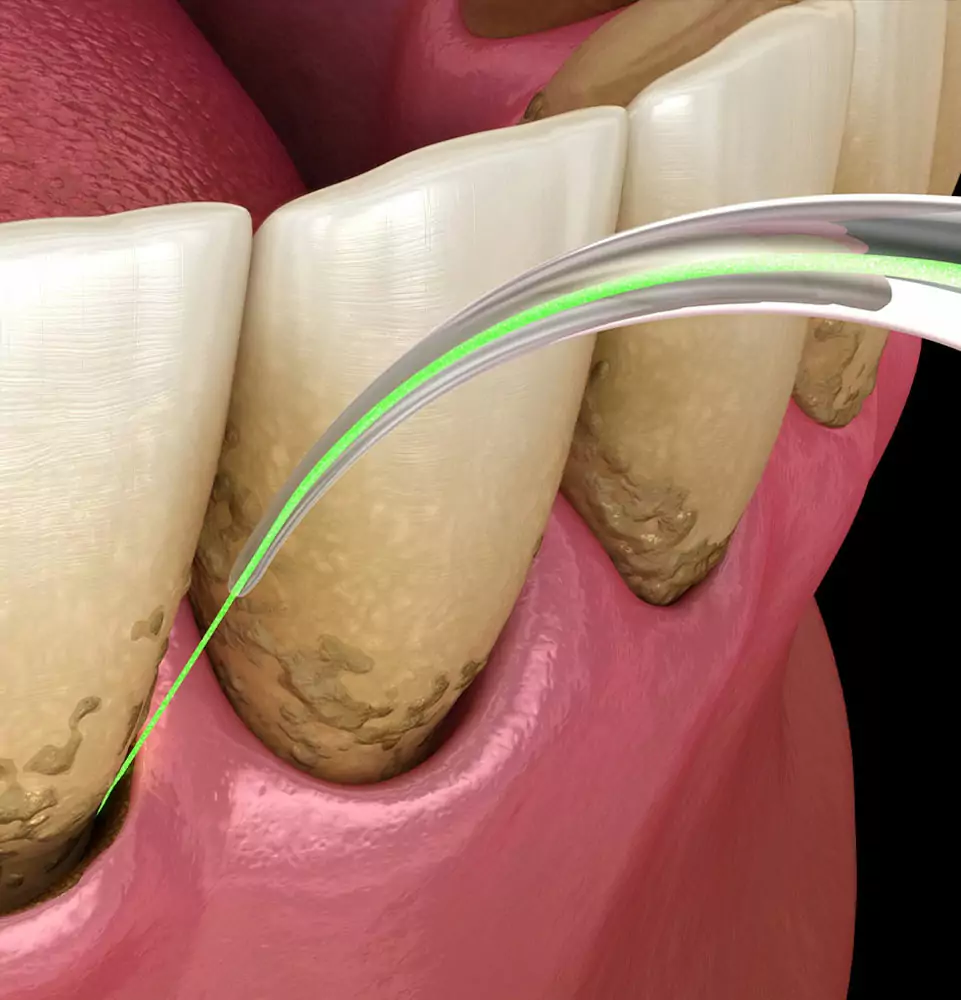 3D illustration of laser periodontal treatment cleaning below the gumline