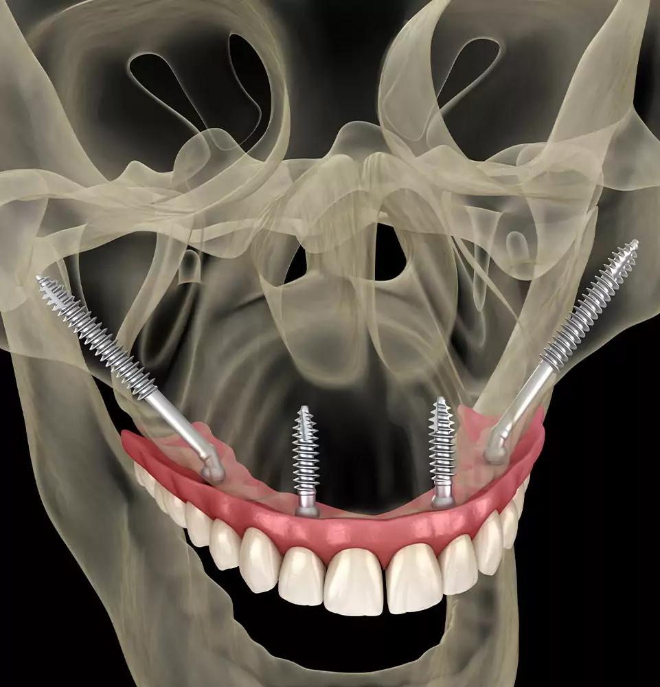 3D illustration of zygomatic implants anchored in the cheekbones supporting a full upper arch